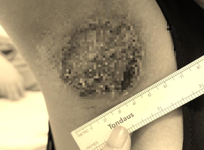 Chữa hôi nách ở spa, bé gái bị hoại tử hai nách nghiêm trọng-1