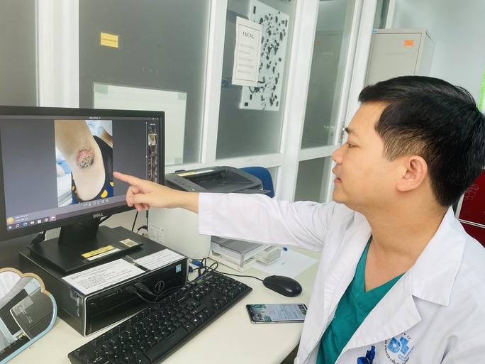 Chữa hôi nách ở spa, bé gái bị hoại tử hai nách nghiêm trọng-2