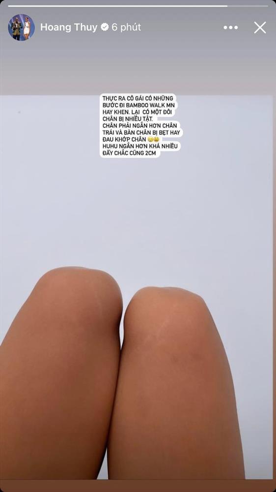 Á hậu - siêu mẫu có đôi chân lệch nhau 2 cm là ai?-1