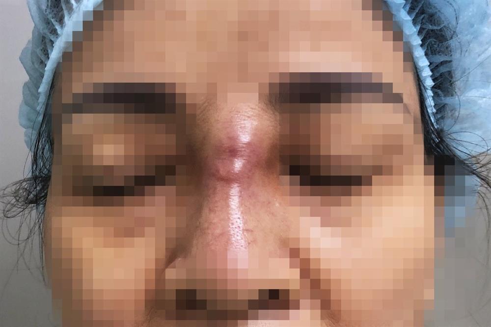 TPHCM: Bị tai biến nặng nề sau khi để người tiêm silicon dạo sửa mũi-1