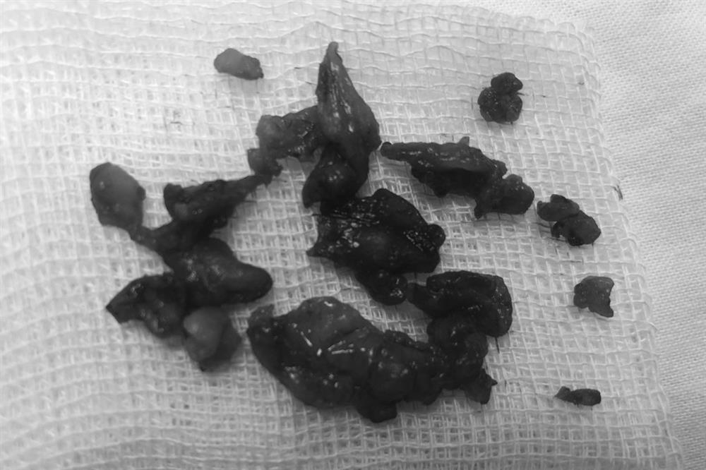 TPHCM: Bị tai biến nặng nề sau khi để người tiêm silicon dạo sửa mũi-3