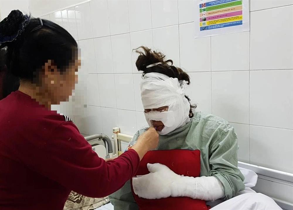 Vụ nổ bóng bay trong lễ khai giảng: Bóng bơm khí dễ phát nổ, gây bỏng rộng-2