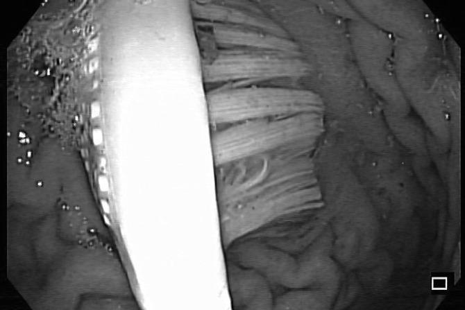 Nữ sinh đại học nuốt bàn chải đánh răng vào bụng-1