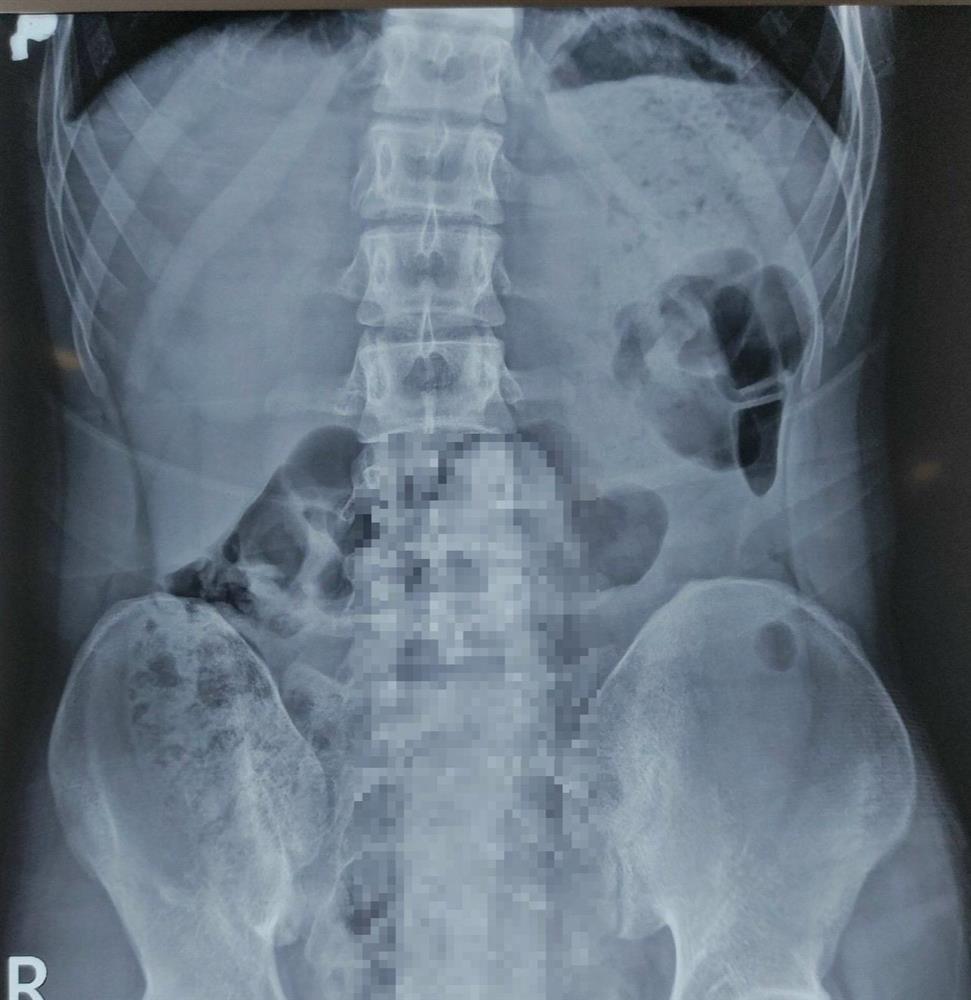 Đồ chơi dài 25cm kẹt trong trực tràng của nam thanh niên-1