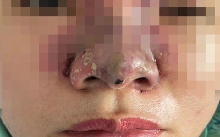 Tiêm filler giá rẻ trong nhà nghỉ, 2 phụ nữ bị tai biến, mất sạch tài sản-1