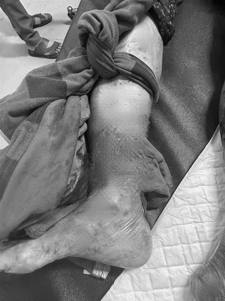 Hà Nội: Một người bị chó nhà cắn gần đứt rời bàn chân-1