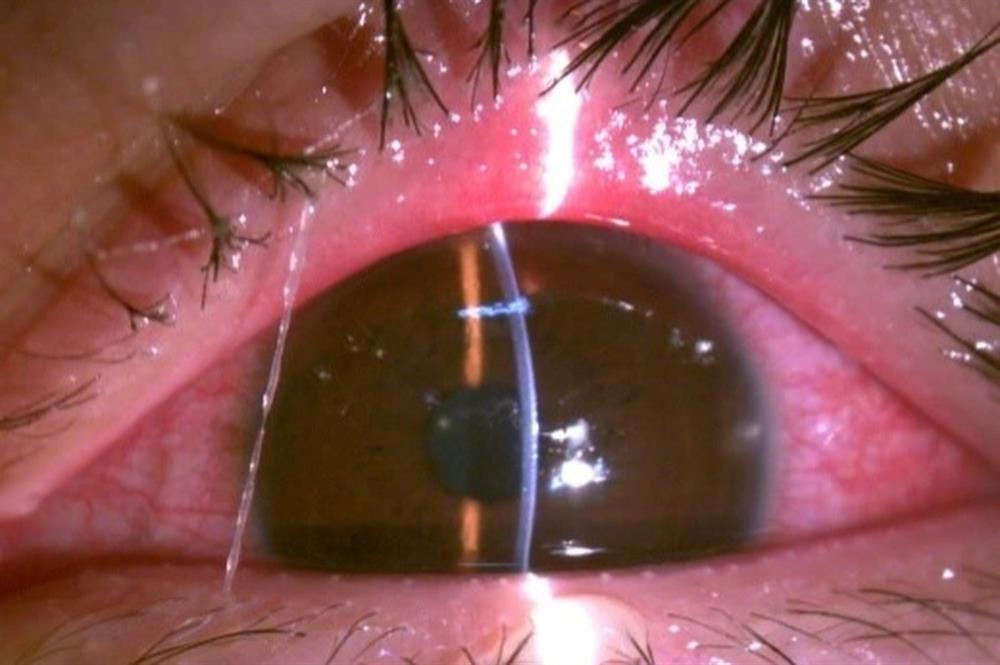Thực hư thông tin bệnh đau mắt đỏ lây lan qua đường nước uống?-1