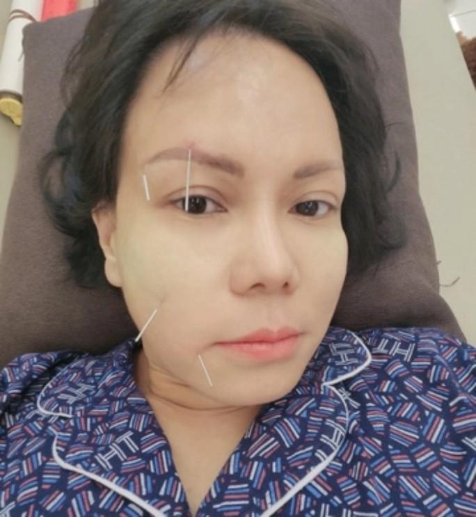 Vài sao Việt không may bị liệt nửa mặt, có người đứng trước nguy cơ đột quỵ-2