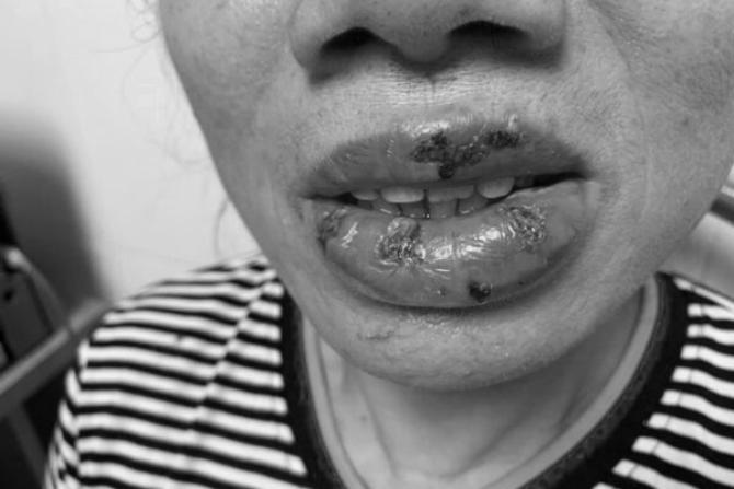 Người phụ nữ U70 cầu cứu bác sĩ sau 5 ngày xăm môi-1