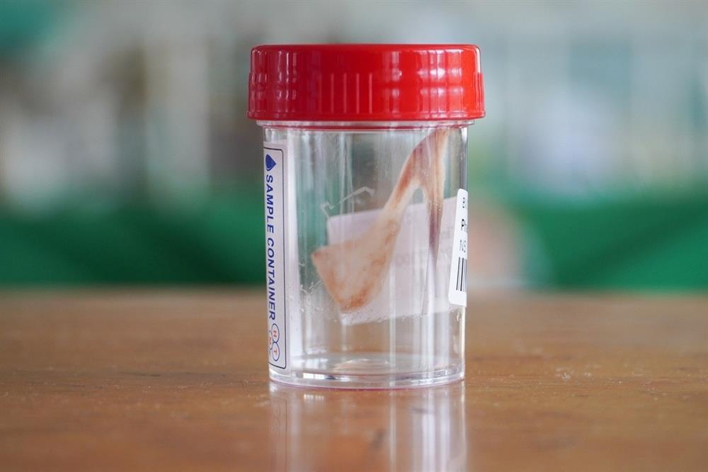 Người đàn ông lâm nguy khi ăn chim cút nhai luôn xương-2