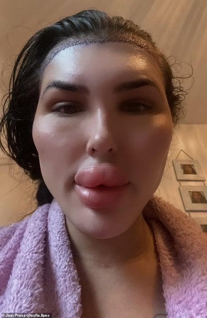 Cô gái chi gần 1,5 tỷ đồng để có đôi môi lớn nhất nước Anh-4