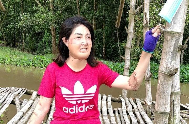 Sau 23 lần phẫu thuật, người phụ nữ từng bị chồng đổ xăng đốt hiện ra sao?-1