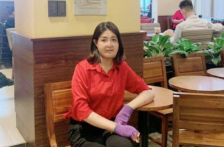 Sau 23 lần phẫu thuật, người phụ nữ từng bị chồng đổ xăng đốt hiện ra sao?-2