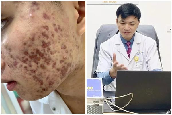 Mẹo xử lý sẹo rỗ phục hồi làn da căng mịn-2