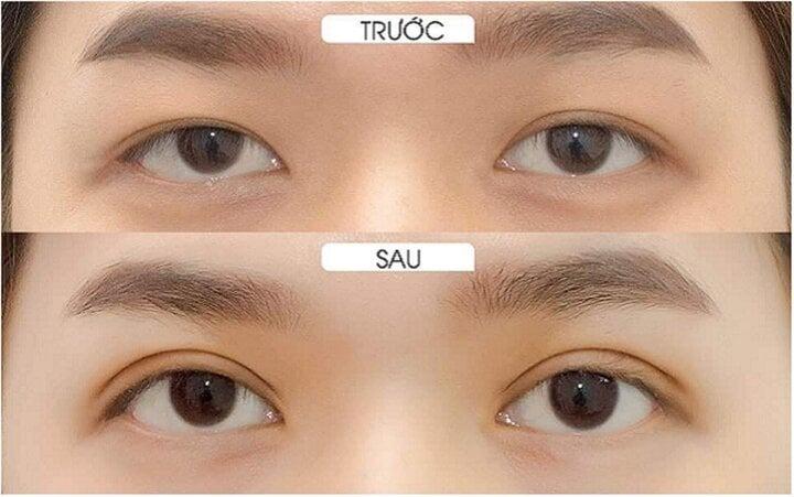 Người bị cận thị có nên cắt mí mắt?-2