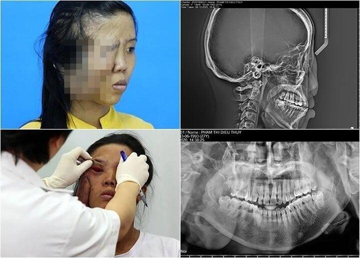 Mẹ đơn thân bị khối u nửa mặt và hành trình lột xác sau 3 cuộc đại phẫu-1