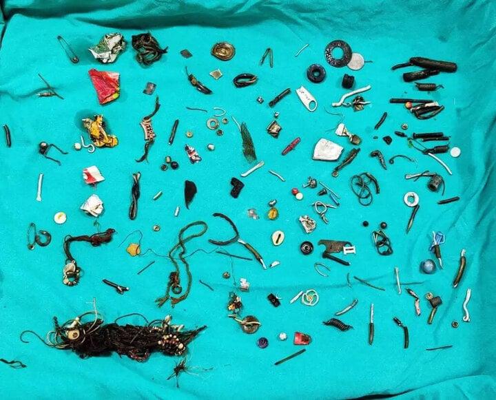 Bác sĩ sốc khi phát hiện cả nhà kho gồm 60 món đồ trong bụng bệnh nhân-1