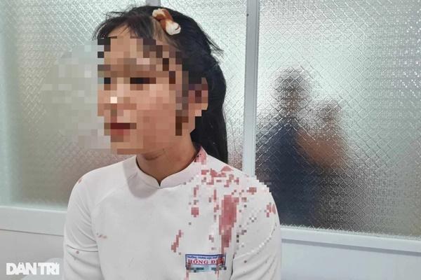 Nữ sinh bị bạn cùng lớp tấn công khi tranh hộp cơm trưa, phải khâu 17 mũi trên mặt-2