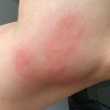 Rệp hút máu lộng hành khắp kinh đô ánh sáng Paris-1