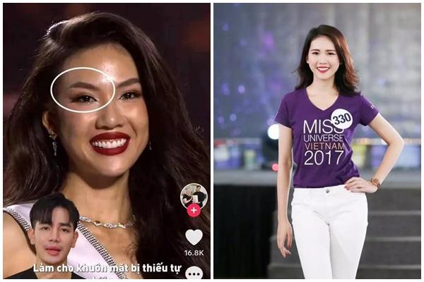 Tiêm filler có an toàn?-2