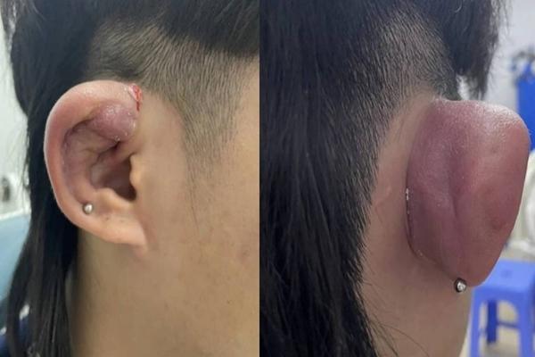 Cằm biến dạng đau đớn sau khi dán cao trị mụn-2