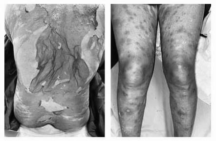 2 người phụ nữ bị hoại tử, lột da do tự ý dùng thuốc đông y-1