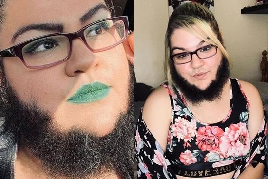 Cô gái có bộ râu rậm dài 10cm vứt bỏ dao cạo, sống hạnh phúc bên bạn trai