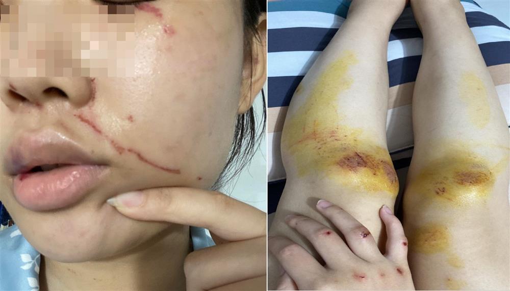 Nữ sinh lớp 11 bị hàng chục người vây đánh, không dám đến trường-1