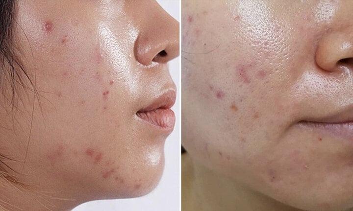 Khắc phục tình trạng da bóng loáng-1