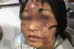 Bé gái 8 tuổi và người phụ nữ bị 'chồng hờ' đánh đập tàn bạo