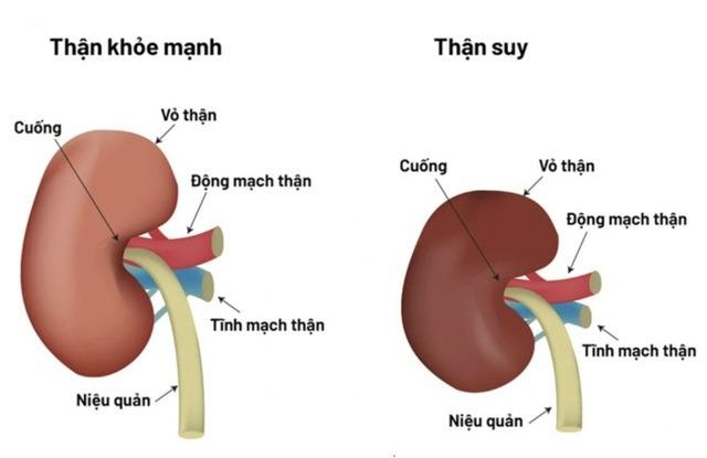 Thực hư công dụng loại cây nhiều người tín nhiệm để chữa thận, nhưng lại chứa chất hại thận khủng khiếp-4