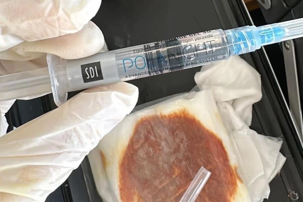 Hoại tử mi mắt vì spa tiêm ống oxy già tẩy trắng răng để làm đẹp-1