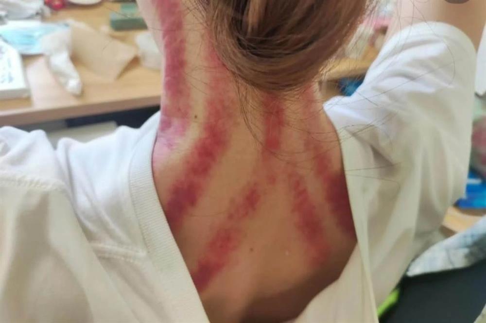 Trào lưu độc lạ: Khoe vết bầm tím do cạo gió như chiến tích lên mạng-2