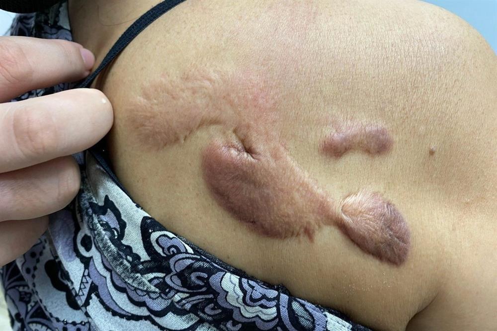 Chi hơn 20 triệu đồng cho spa, nhận lại sẹo như đỉa trâu-1