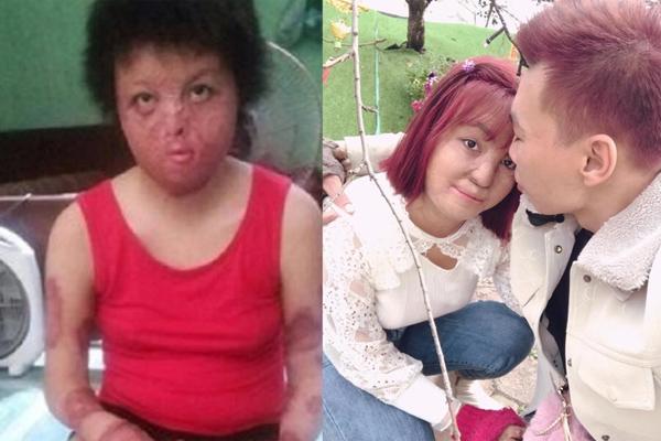 Việt kiều Canada bị tạt axit, cắt gân chân lần đầu tiên lộ diện với gương mặt không đeo khẩu trang-7