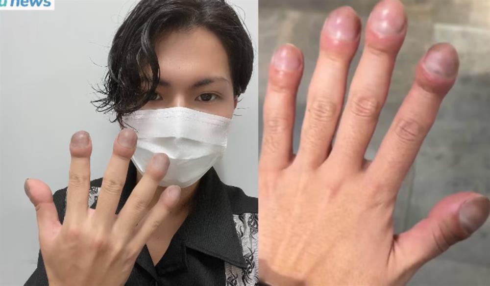 Nhà tạo mẫu tóc nổi khắp Nhật Bản vì ngón tay sưng to lạ lùng-1