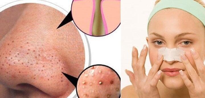 Nặn mụn đầu đen ở mũi thế nào cho đỡ hại da?-2