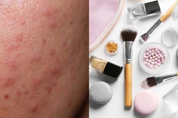 Bột Talc trong mỹ phẩm có tác dụng gì, liệu có gây ung thư?-3