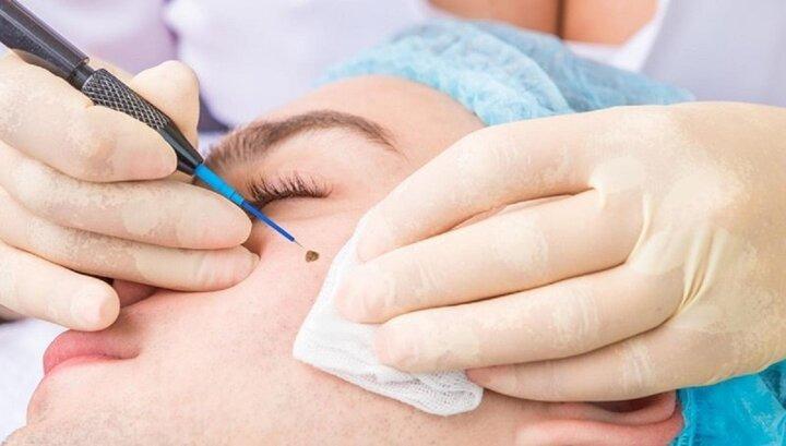 Có thể tẩy nốt ruồi bằng kem đánh răng?-2