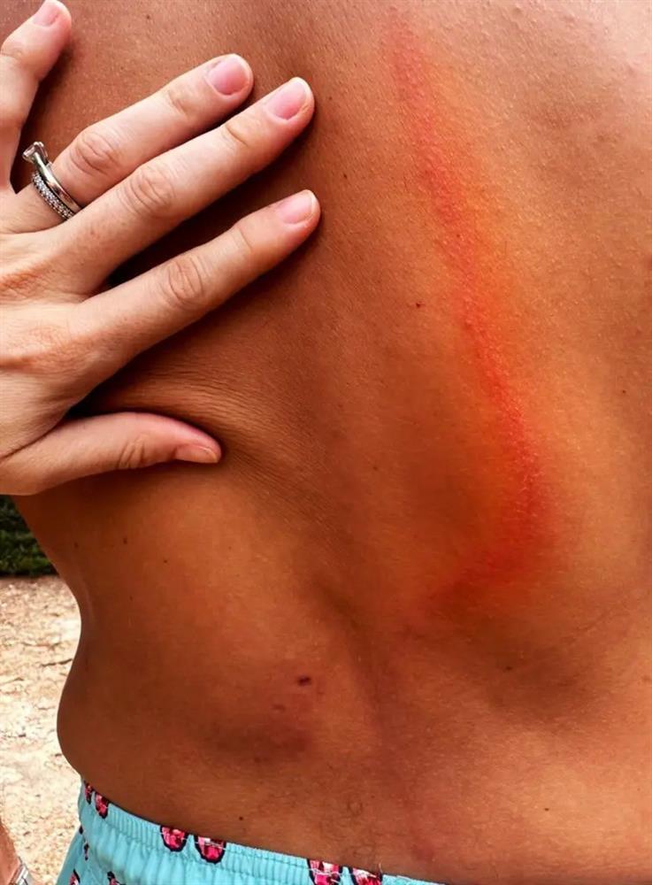 Du khách mải mê chụp ảnh bị nai sừng húc gãy xương sườn, suýt toạc lưng-3