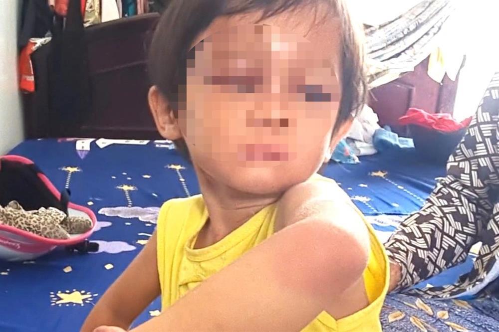 Bé gái 4 tuổi nghi bị cha nuôi bạo hành-1