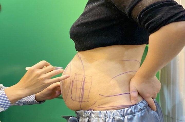 Tại sao bạn vẫn phải tập luyện sau khi hút mỡ?-2