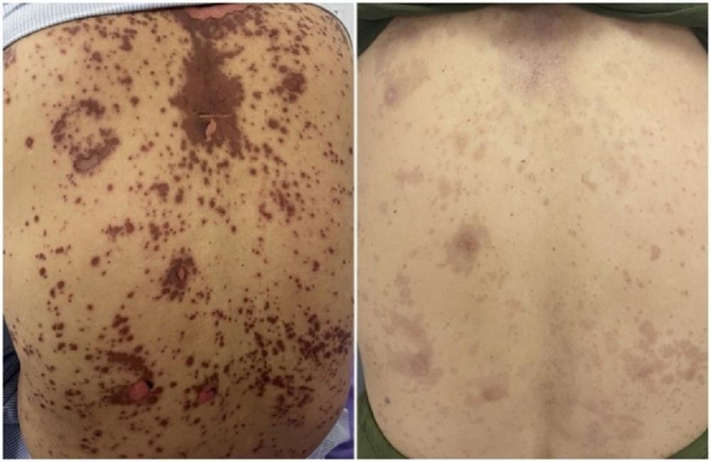 Dùng thuốc nam, người phụ nữ U60 da bỗng đỏ thẫm và nhăn nheo-1