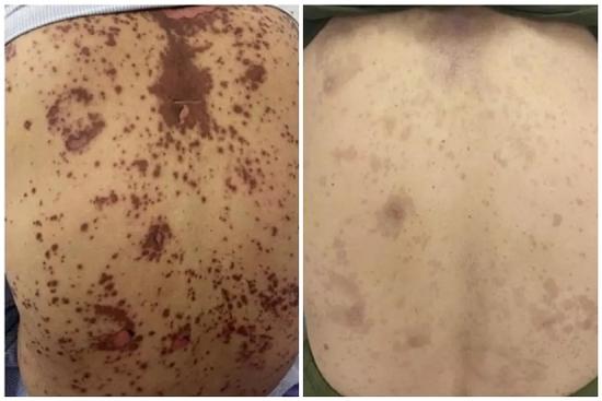 Dùng thuốc nam, người phụ nữ U60 da bỗng đỏ thẫm và nhăn nheo