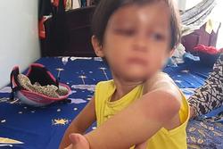 Bắt tạm giam cha nuôi bạo hành bé gái 4 tuổi ở Cà Mau