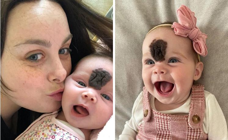 Bé gái có vết bớt hiếm gặp giữa trán, diện mạo hiện tại gây ngỡ ngàng-1