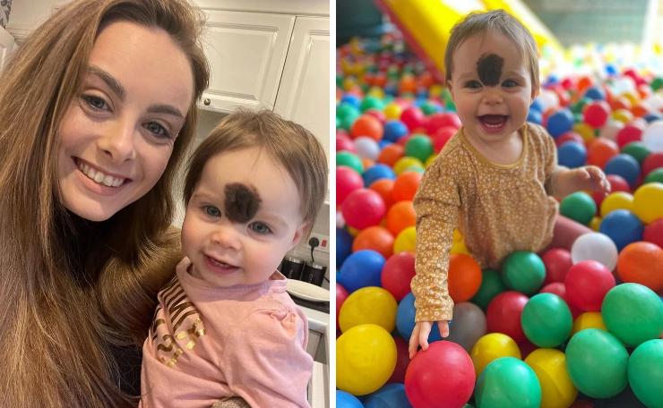 Bé gái có vết bớt hiếm gặp giữa trán, diện mạo hiện tại gây ngỡ ngàng-2