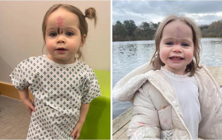 Bé gái có vết bớt hiếm gặp giữa trán, diện mạo hiện tại gây ngỡ ngàng-3