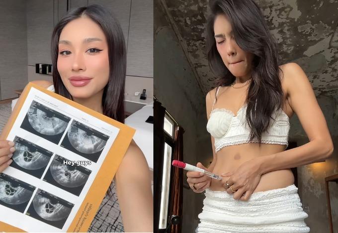 Người trẻ đông lạnh trứng để không bị áp lực kết hôn khi già-2