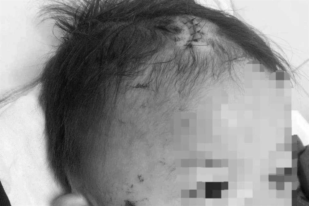 Công an xác minh tin bé 2 tuổi bị kẻ gây tai nạn ném vào bụi gây vỡ sọ-1